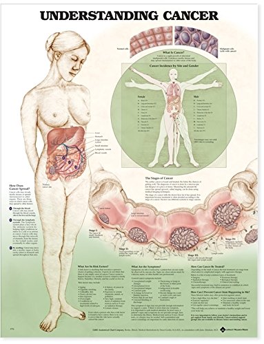 Understanding Cancer Anatomical Chart (9781587797606) by Anatomical Chart Company