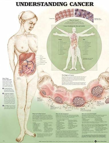 Understanding Cancer Chart (9781587797613) by Anatomical Chart Company