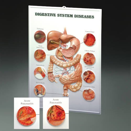 Digestive System Diseases: Lenticular Chart (9781587799051) by Anatomical Chart Company