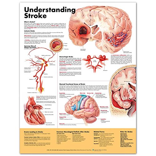 Stock image for Understanding Stroke Anatomical Chart for sale by Revaluation Books