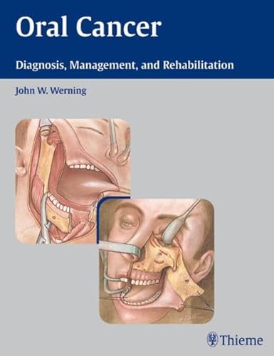 9781588903099: Oral Cancer: Diagnosis, Management, and Rehabilitation