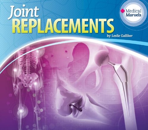 9781617839030: Joint Replacements (Medical Marvels)