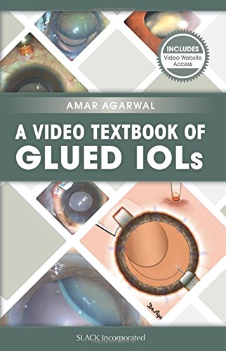 9781630912246: A Video Textbook of Glued IOLs