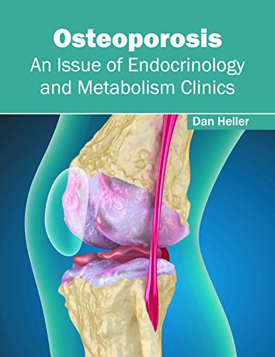 Stock image for Osteoporosis: An Issue of Endocrinology and Metabolism Clinics for sale by Romtrade Corp.