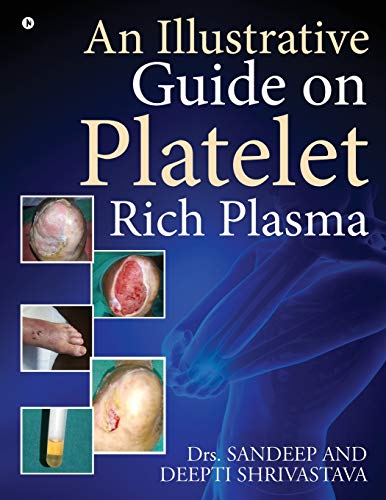 Stock image for An Illustrative Guide on Platelet Rich Plasma for sale by GF Books, Inc.
