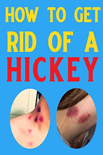 9781794076266: how to get rid of a hickey: 39 Natural Remedies to get rid of a hickey fast