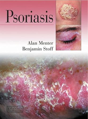 Psoriasis - Stoff, Benjamin, Menter, Alan