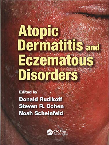 Beispielbild fr Atopic Dermatitis and Eczematous Disorders zum Verkauf von BooksRun