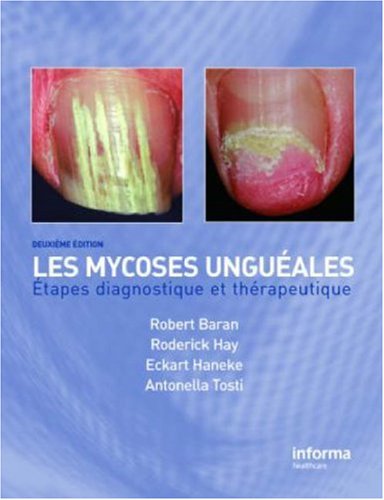 Stock image for Onychomycosis/Les mycoses ungueales: Etapes diagnostique et clinique for sale by Book Deals