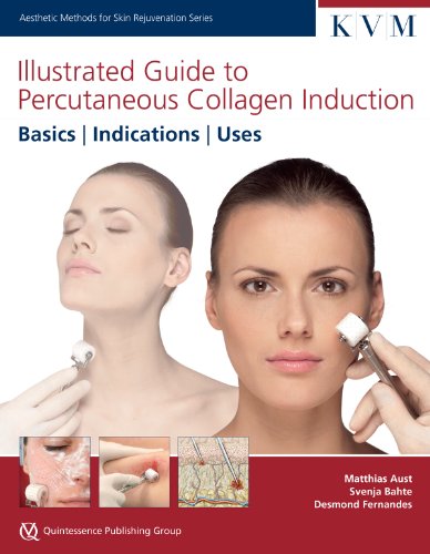Stock image for Illustrated Guide to Percutaneous Collagen Induction: Basics / Indications / Uses for sale by Revaluation Books