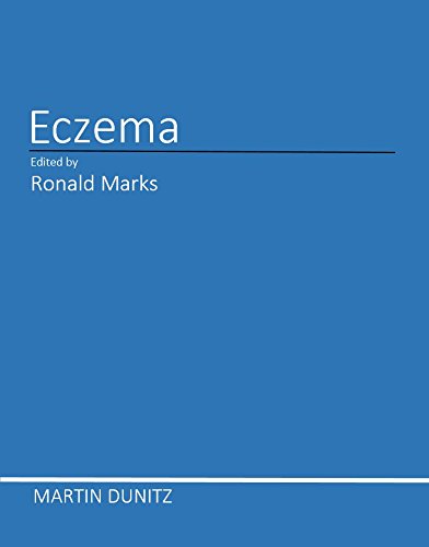 Stock image for Eczema for sale by Zubal-Books, Since 1961