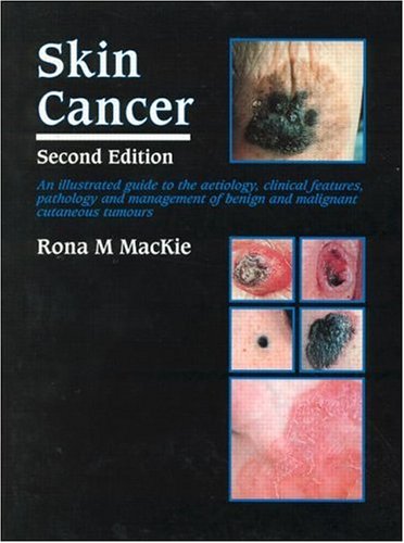 Beispielbild fr Skin Cancer: An Illustrated Guide to the Aetiology, Clinical Features, Pathology and Management of Benign and Malignant Cutaneous Tumours zum Verkauf von HPB-Red