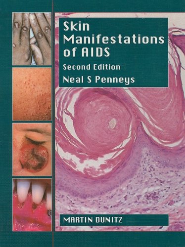Beispielbild fr Skin Manifestations Of Aids, Second Edition zum Verkauf von WorldofBooks