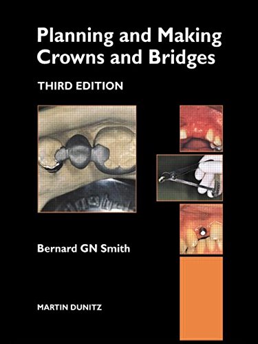 Planning and Making Crowns and Bridges (9781853173141) by Smith, Bernard GN; Smith, Bernard G.n.