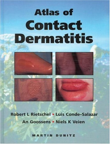 Stock image for An Atlas of Contact Dermatitis for sale by Zubal-Books, Since 1961