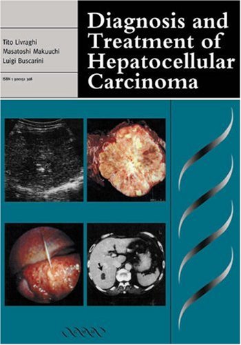 Diagnosis and Treatment of Hepatocellular Carcinoma