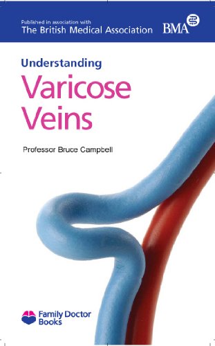 Imagen de archivo de Varicose Veins (Understanding) (Family Doctor Books) a la venta por WorldofBooks