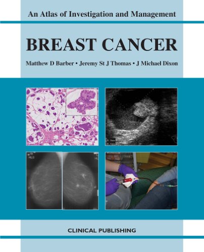 Beispielbild fr Breast Cancer zum Verkauf von Blackwell's