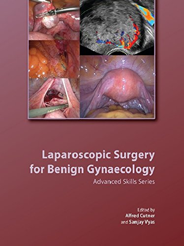 Beispielbild fr Laparoscopic Surgery for Benign Gynaecology: Advanced Skills Series zum Verkauf von AwesomeBooks