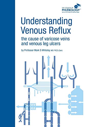 Beispielbild fr Understanding Venous Reflux the Cause of Varicose Veins and Venous Leg Ulcers: Varicose veins and venous leg ulcers (College of Phlebology) zum Verkauf von SecondSale