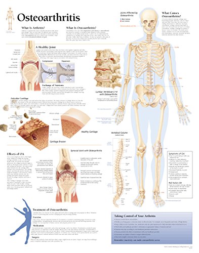 9781930633148: Osteoarthritis Paper Poster