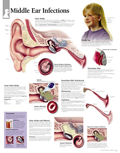 Middle Ear Infection chart: Laminated Wall Chart (9781930633193) by [???]