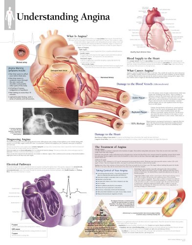 9781930633223: Understanding Angina, Paper Chart