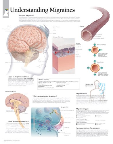 Understanding Migraines chart: Laminated Wall Chart (9781932922189) by [???]