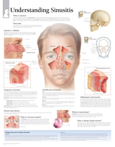 Understanding Sinusitis chart: Laminated Wall Chart (9781932922691) by [???]