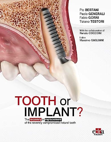 Imagen de archivo de Tooth or Implant a la venta por libreriauniversitaria.it