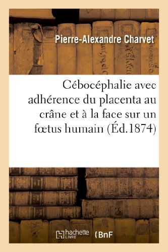 Stock image for Cbocphalie Avec Adhrence Du Placenta Au Crne Et  La Face Sur Un Foetus Humain (Sciences) (French Edition) for sale by Lucky's Textbooks