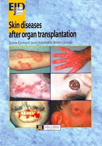 Beispielbild fr Skin diseases after organ transplatation zum Verkauf von Chapitre.com : livres et presse ancienne