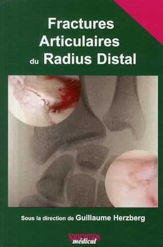 Stock image for FRACTURES ARTICULAIRES DU RADIUS DISTAL for sale by Gallix