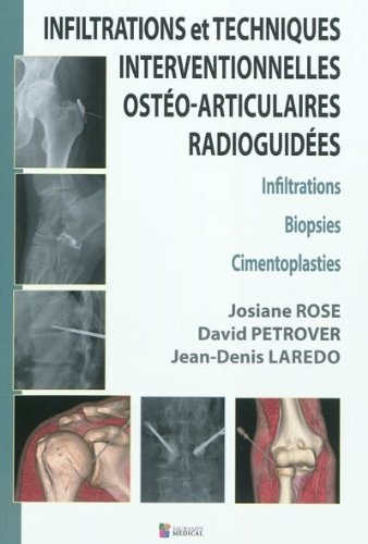 Stock image for INFILTRATIONS ET TECHNIQUES INTERVENTIONNELLES OSTEO-ARTICULAIRES RADIOGUIDEES (0000) for sale by Gallix