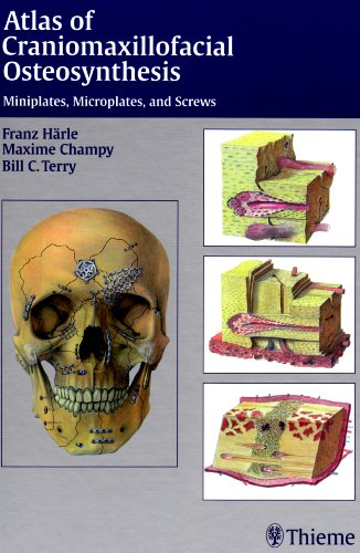 Atlas of Craniomaxillofacial Osteosynthesis Microplates, Miniplates, and Screws - Härle, Franz, Maxime Champy und Bill C Terry