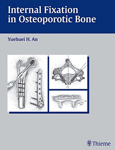 Imagen de archivo de Internal Fixation in Osteoporotic Bone a la venta por HPB-Red