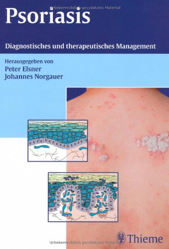 Beispielbild fr Handbuch der Psoriasis: Diagnostisches und therapeutisches Management zum Verkauf von medimops