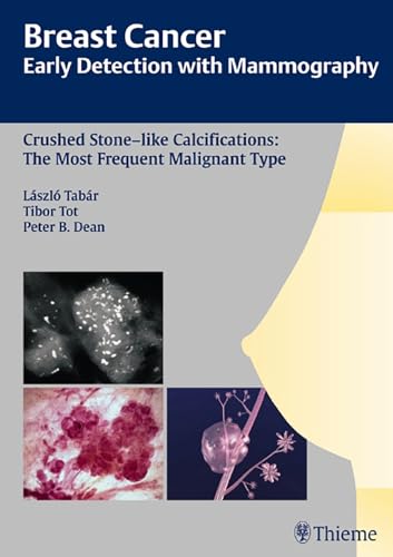 Beispielbild fr Breast Cancer: Early Detection with Mammography: Crushed Stone-like Calcifications: The Most Frequent Malignant Type (Tabar Mammo) zum Verkauf von Zoom Books Company