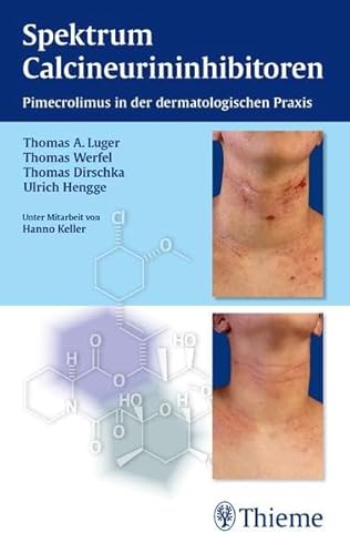 9783131740717: Spektrum Calcineurininhibitoren: Pimecrolimus in der dermatologischen Praxis