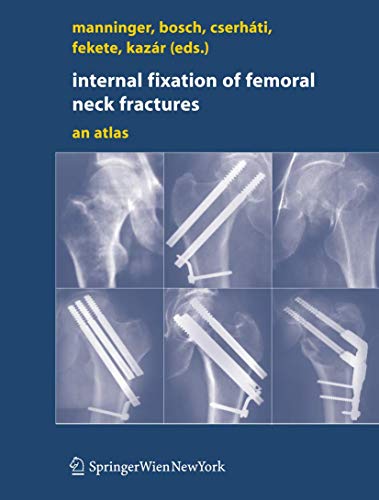 Internal fixation of femoral neck fractures: An Atlas