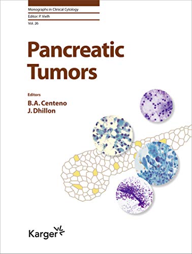 Stock image for Pancreatic Tumors (Monographs in Clinical Cytology) for sale by SecondSale