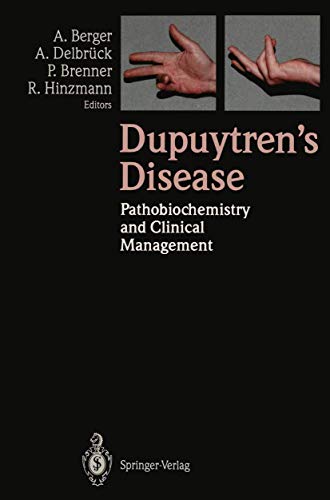 Dupuytren?S Disease: Pathobiochemistry And Clinical Managementj