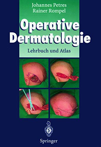 Operative Dermatologie: Lehrbuch und Atlas [Gebundene Ausgabe] Basaliom Melanom Operative Dermatologie Plastische Chirurgie Wunddeckung Wundheilung Johannes Petres (Autor), Rainer Rompel (Autor) Basaliom Melanom Operative Dermatologie Plastische Chirurgie Wunddeckung Wundheilung Das von zwei erfahrenen Dermatologen verfaßte Werk, Lehrbuch und Atlas zugleich, ist eine von Umfang und Bildausstattung herausragende Dokumentation der Leistungsbreite der operativen Dermatologie und ihrer Schnittstellen zu den anderen FachgebietenDas Werk, das derzeit in der deutschsprachigen Literatur seinesgleichen sucht, kann als umfassende Operationslehre Dermatologen in Klinik und Praxis empfohlen werden.