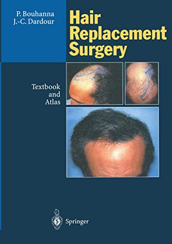 9783540590309: Hair Replacement Surgery: Textbook and Atlas