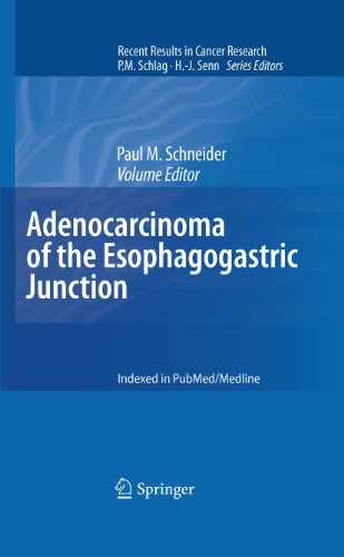 Adenocarcinoma of the Esophagogastric Junction.