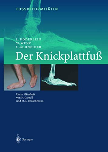 9783642631573: Fussdeformitten: Der Knickplattfuss