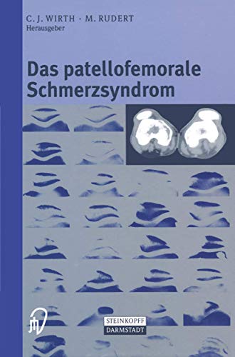 9783642633348: Das patellofemorale Schmerzsyndrom