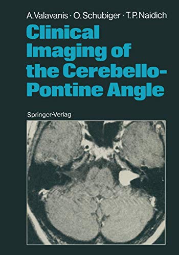 Clinical Imaging of the Cerebello-Pontine Angle (9783642712067) by Valavanis, Anton; Schubiger, Othmar; Naidich, Thomas P.