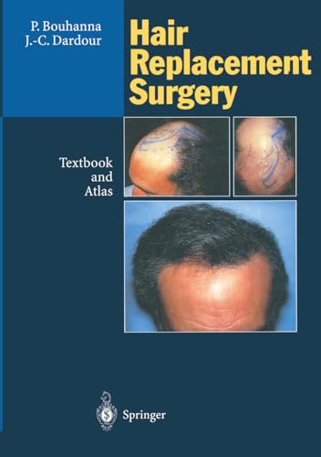 9783642796142: Hair Replacement Surgery: Textbook and Atlas