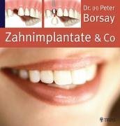 9783830432753: Zahnimplantate & Co. Die Implantologie in der modernen Zahnheilkunde